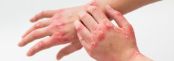 Eczema: saiba o que é e como cuidar da pele